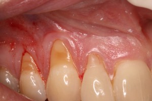 Receding Gums & Tooth Sensitivity