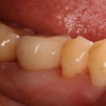 Dental implant with 1 porcelain restorative crown.