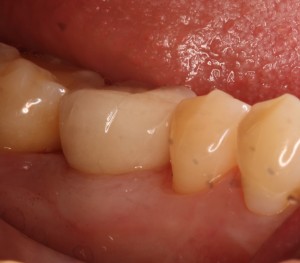 Dental implant with 1 porcelain restorative crown.