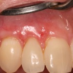 Correction of receding gums & tooth sensitivity