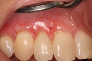 Correction of receding gums & tooth sensitivity