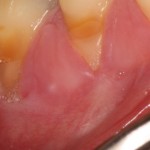 Receding gums before surgical treatment.