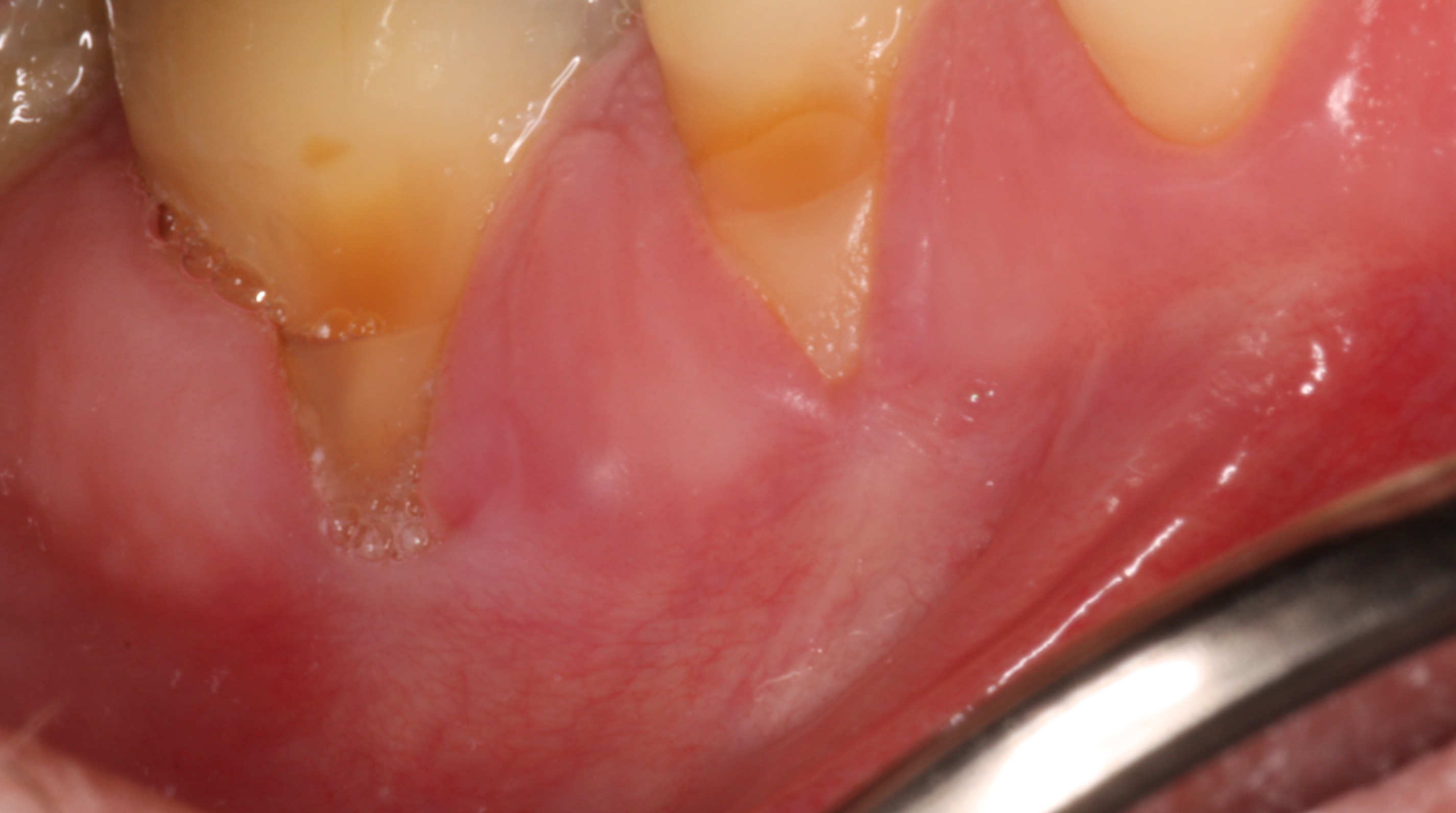 Receding gums before surgical treatment.