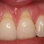 Gum recession before treatment.