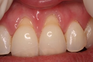 Gum recession before treatment.