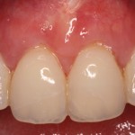 Treatment of gum recession with a allograft.