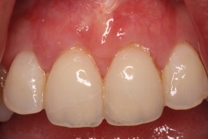 Treatment of gum recession with a allograft.