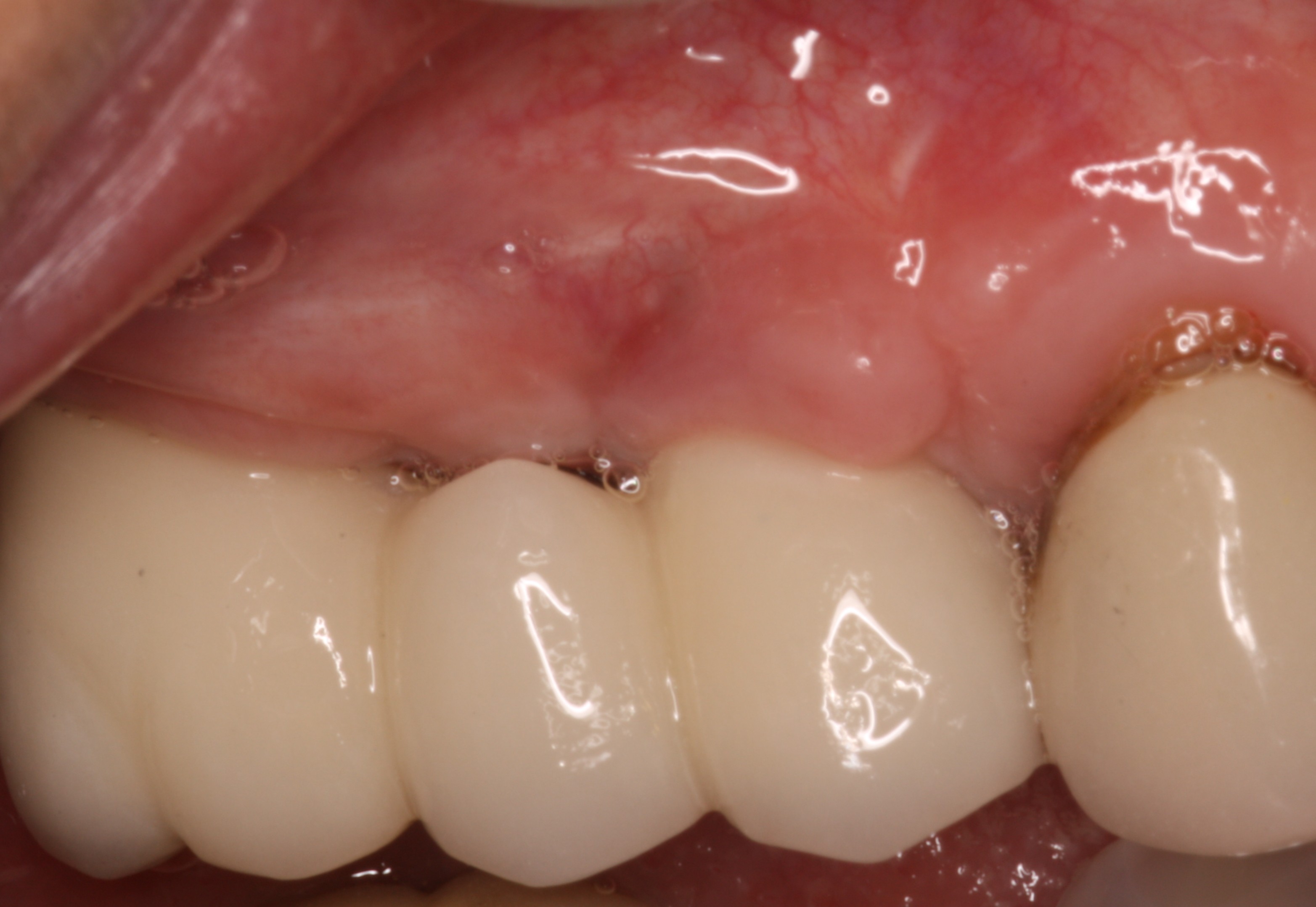 Bridge supported by 2 dental implants.