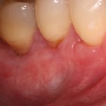 Surgical treatment of receding gums.