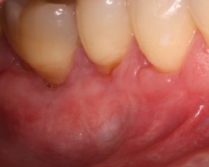 Surgical treatment of receding gums.