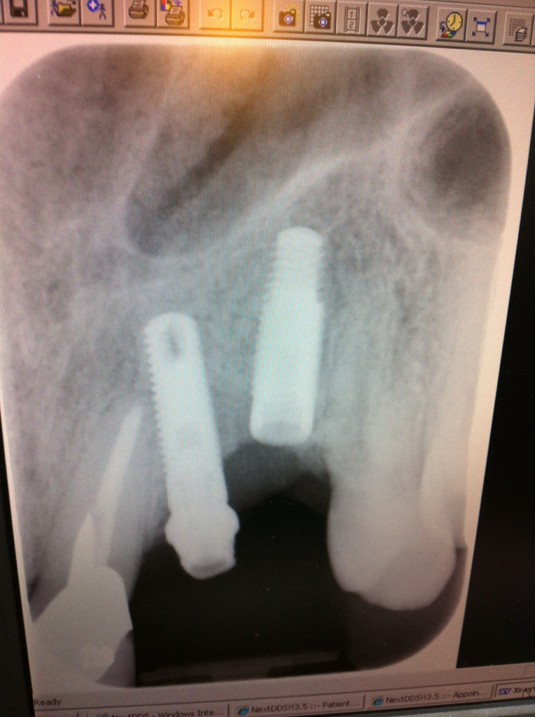 Non-parallel dental implants