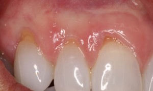 Root exposure can cause teeth to appear longer.