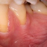 Receding gums before a grafting procedure.