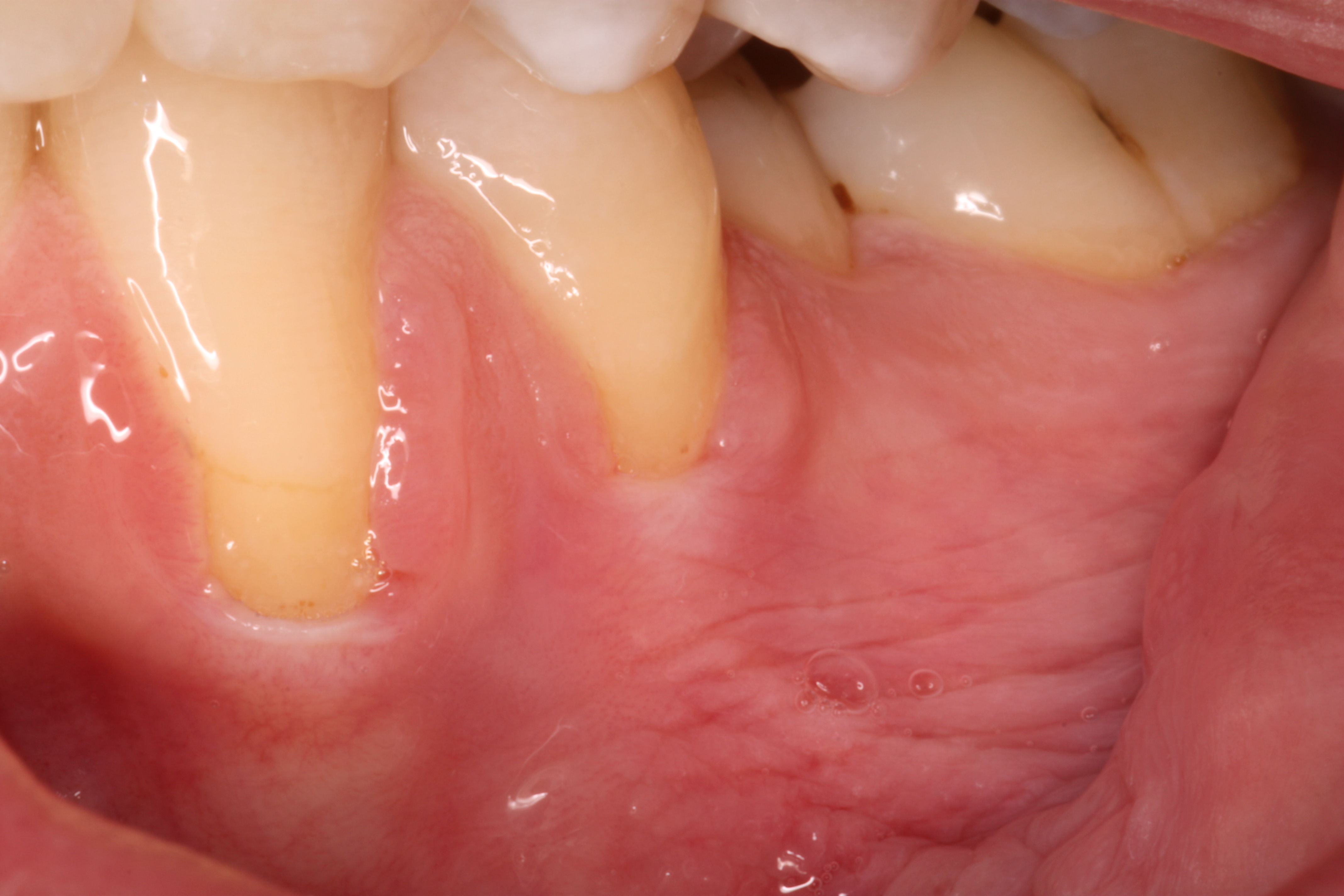 Receding gums before a grafting procedure.