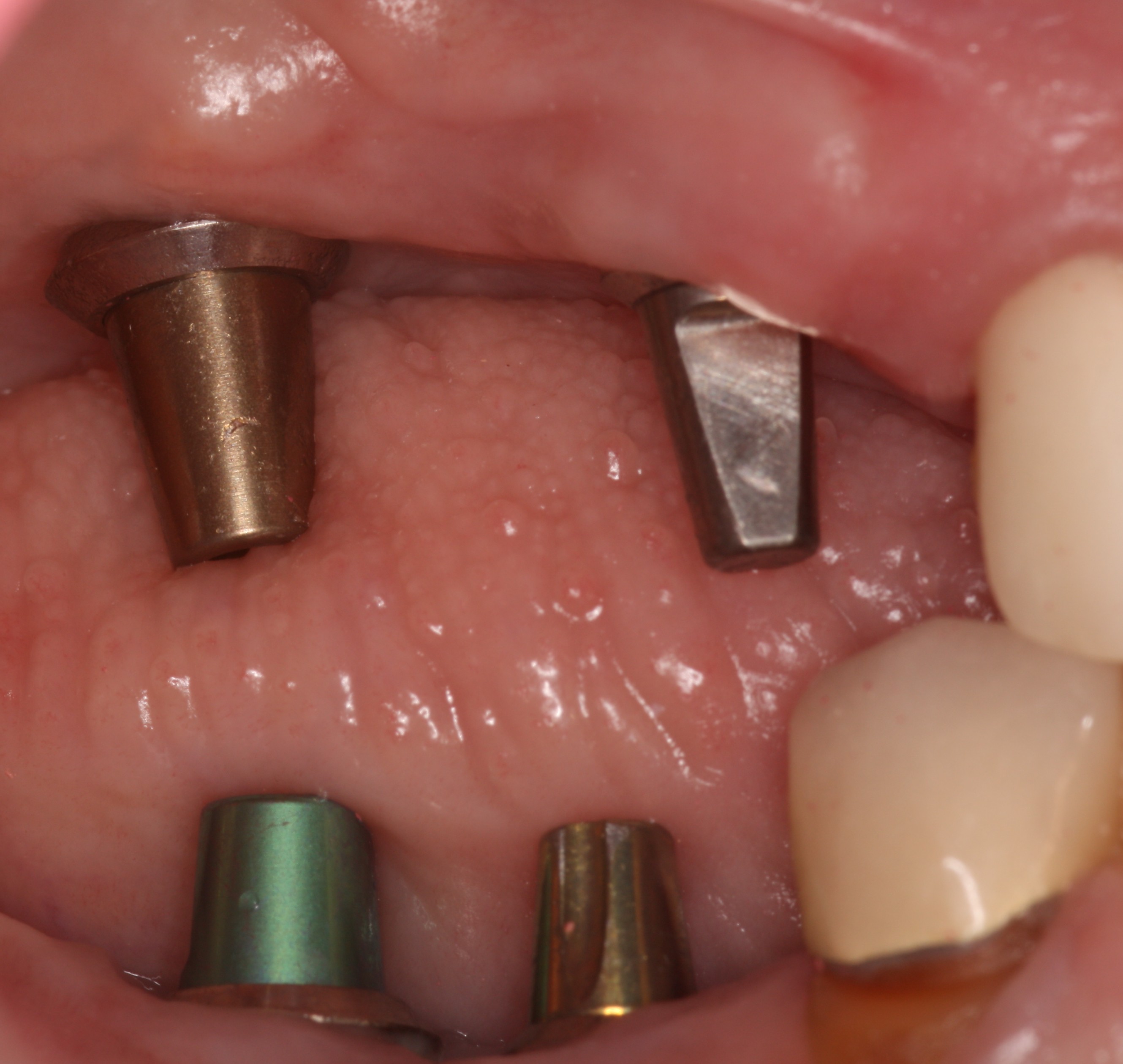 Upper & Lower Dental Implants with solid abutments.