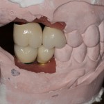 Lab mounted dental implants to cast models.