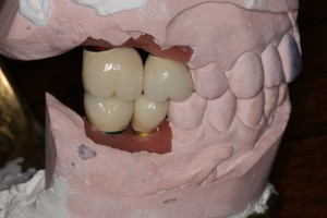 Lab mounted dental implants to cast models.