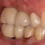 Upper & Lower Dental Implants-Restorations