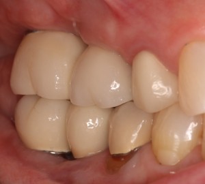 Upper & Lower Dental Implants-Restorations