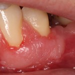 Gum grafting completed before orthodontic treatment.