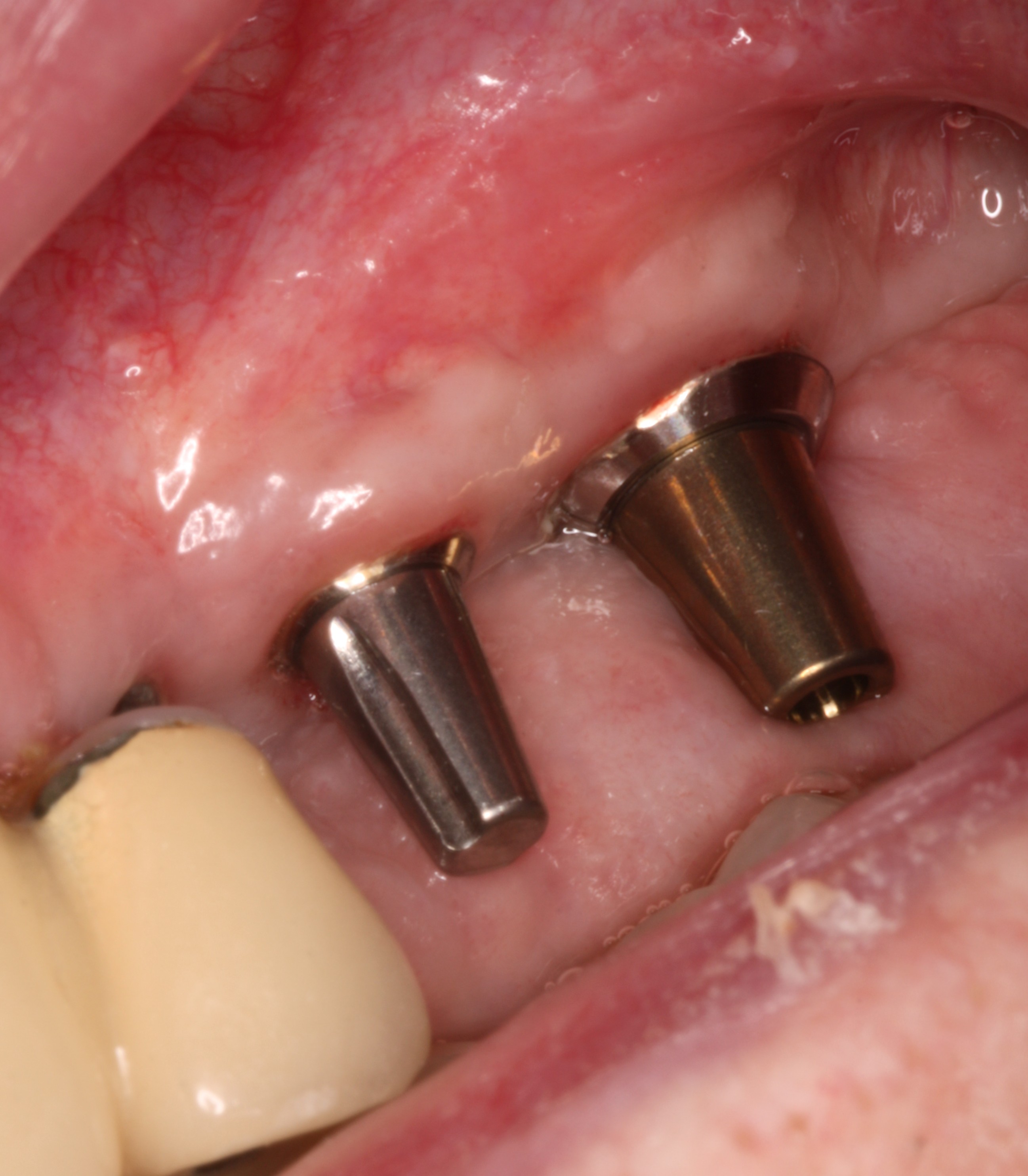 Dental implants with abutments ready for restorative treatment.
