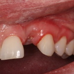 Pre dental implant and temporary restoration-Teeth in an hour