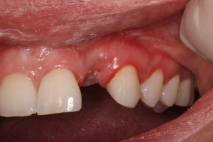 Pre dental implant and temporary restoration-Teeth in an hour