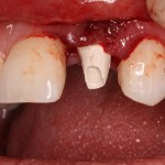 Dental implant temporary abutment-Teeth in an hour