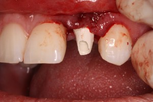 Dental implant temporary abutment-Teeth in an hour