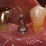 Prognosis-Dental Implants & Gum Disease