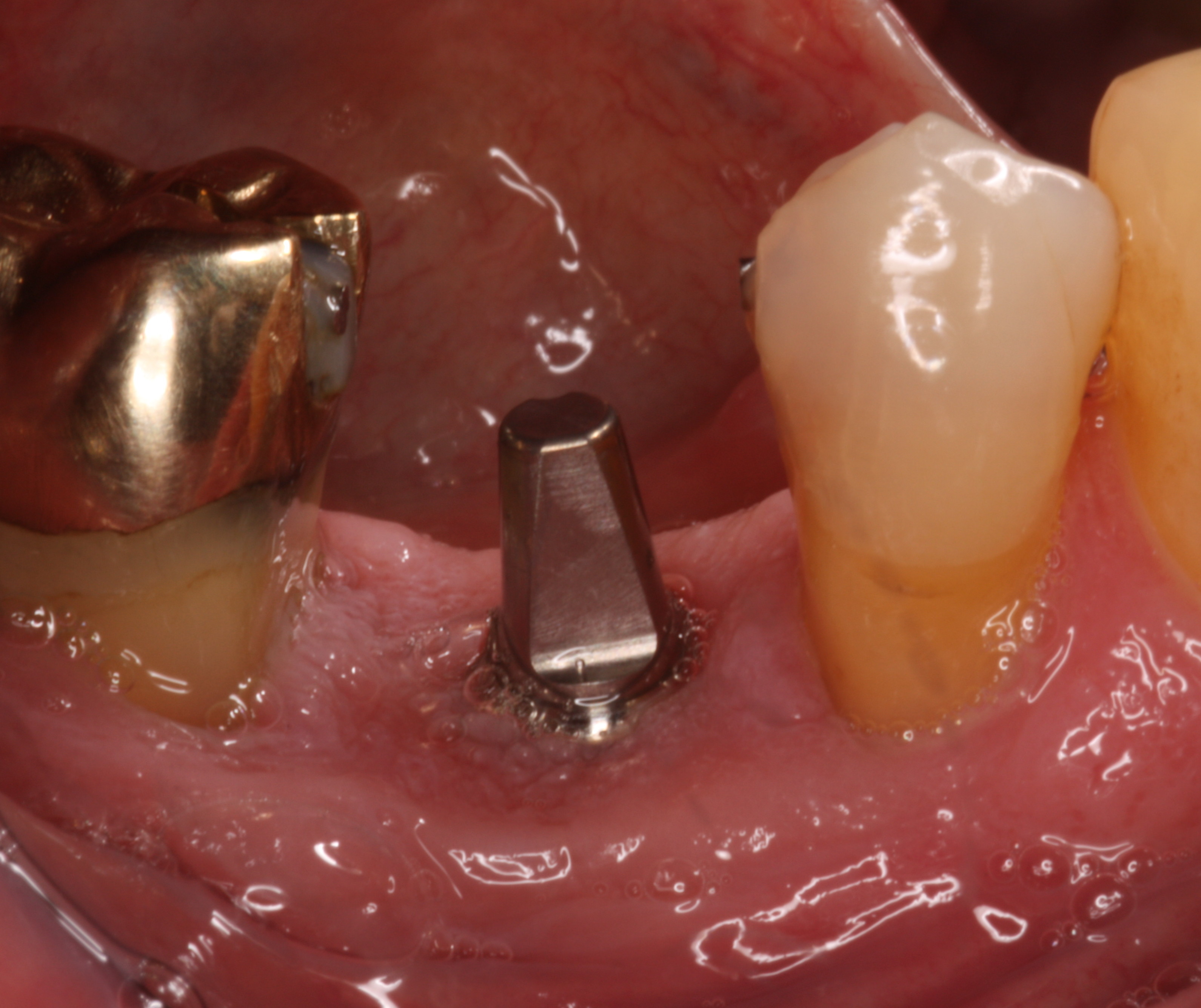 Prognosis-Dental Implants & Gum Disease
