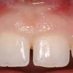 Excess Gingival Display