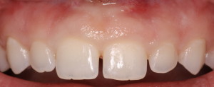 Excess Gingival Display