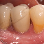 Risk of gum disease & dental implants.