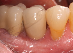 Risk of gum disease & dental implants.