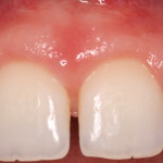 Correction of Excess Gingival Display