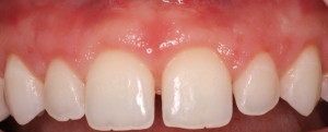 Correction of Excess Gingival Display