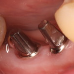 dental implants pre restorative