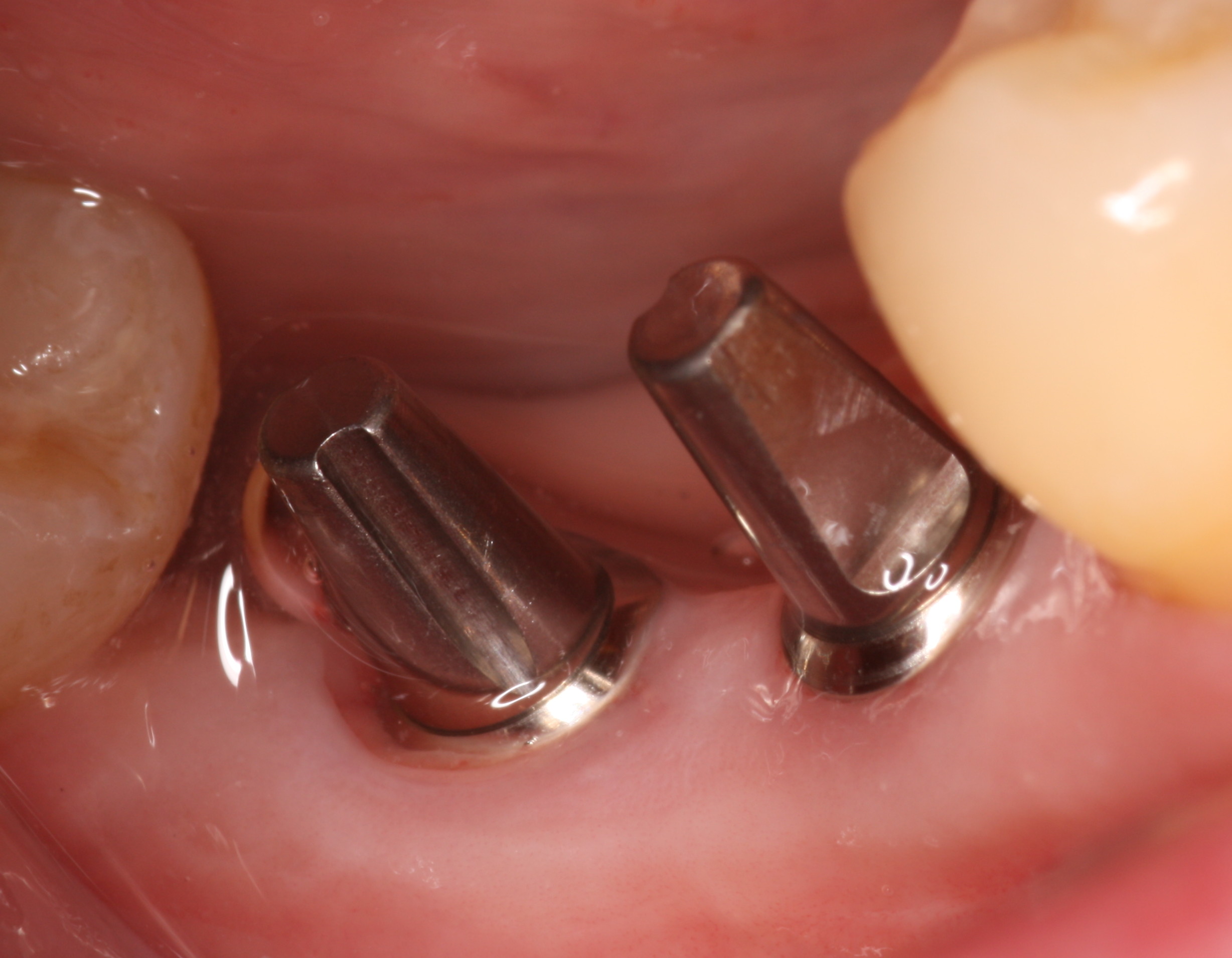 dental implants pre restorative