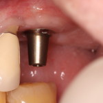 Dental Implant & Titanium Allergy?
