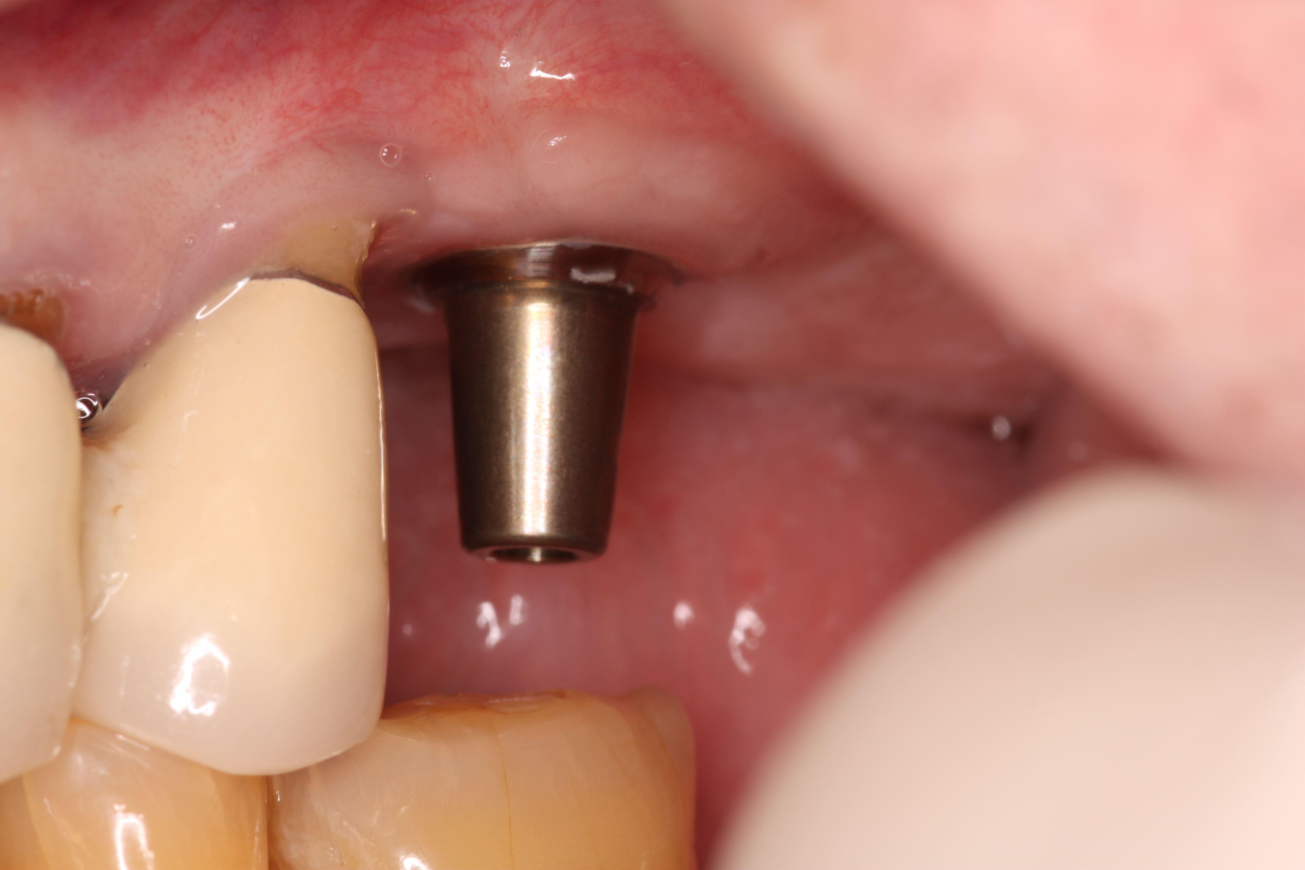Dental Implant & Titanium Allergy?