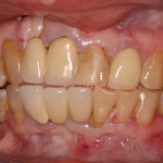 Dental Implants & Dental Tourism