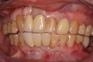 Dental Implants & Dental Tourism