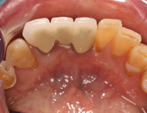 Dental implants placed in a foreign country.