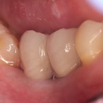 Dental Implants-Porcelain Crowns