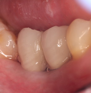 Dental Implants-Porcelain Crowns