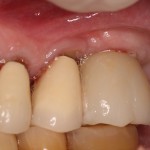 Allergy to Dental Implants