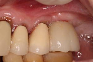 Allergy to Dental Implants