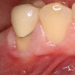 Inflamed & receding gums