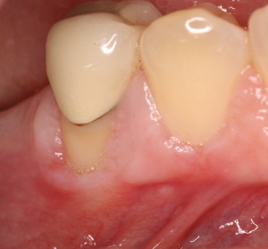 Inflamed & receding gums